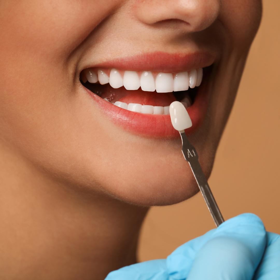 Porcelain Veneers