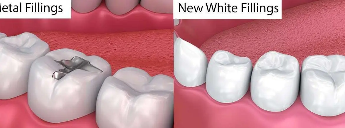 White Fillings
