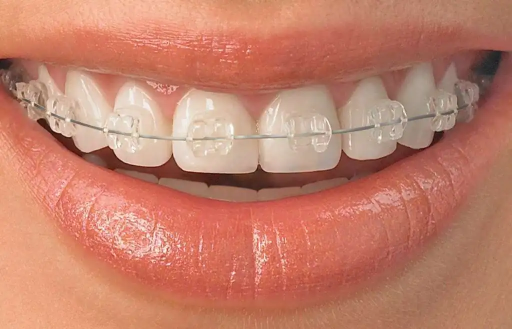 Invisible Braces